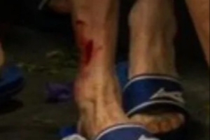 紅牌也不冤！被帕利尼亞蹬踏的波鴻球員，賽后小腿創(chuàng)口依然明顯